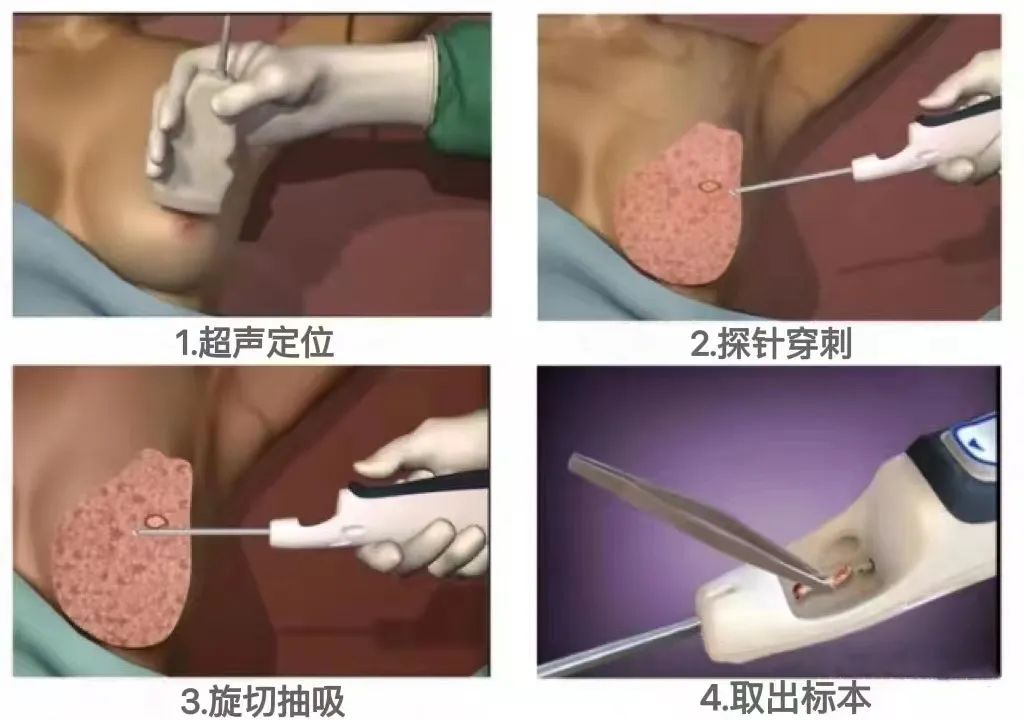 「硬實(shí)力」小切口解決大麻煩——乳腺微創(chuàng)旋切術(shù)讓美麗不留憾