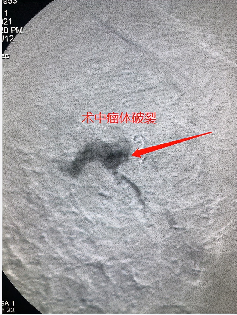 與時間賽跑，介入顯神通