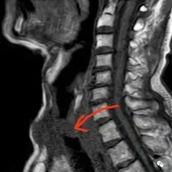 「胸科速度」半小時完成氣管支架置入術(shù) 成就患者過團(tuán)圓年
