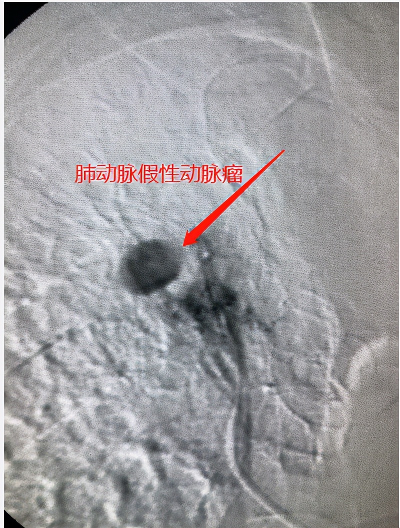 與時間賽跑，介入顯神通