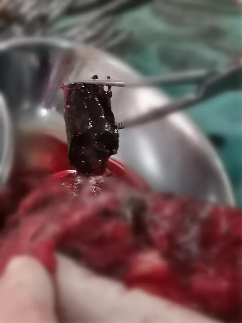 「驚愕」手術(shù)臺上忽見40多年的“老朋友”