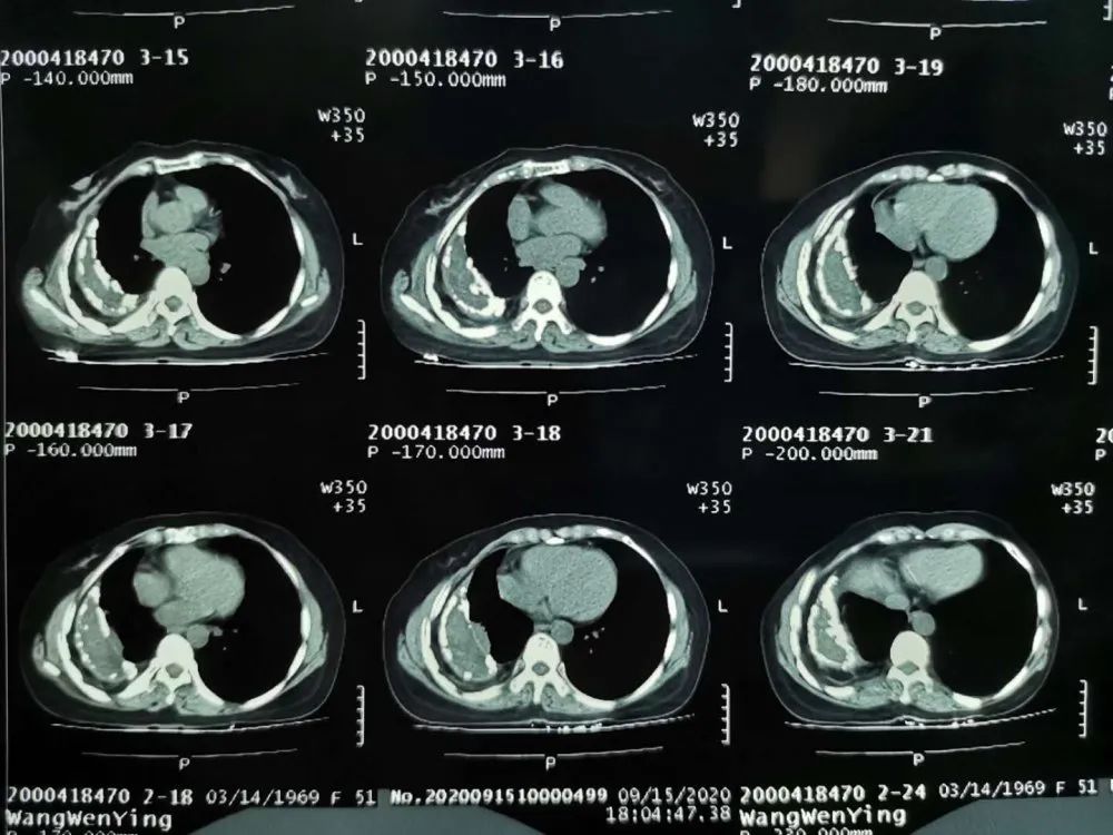 「科普」 你知道嗎？是你囚禁了自己的肺