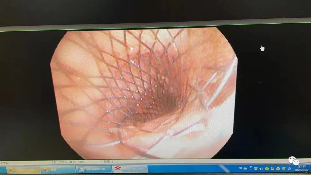 「胸科速度」半小時完成氣管支架置入術(shù) 成就患者過團(tuán)圓年