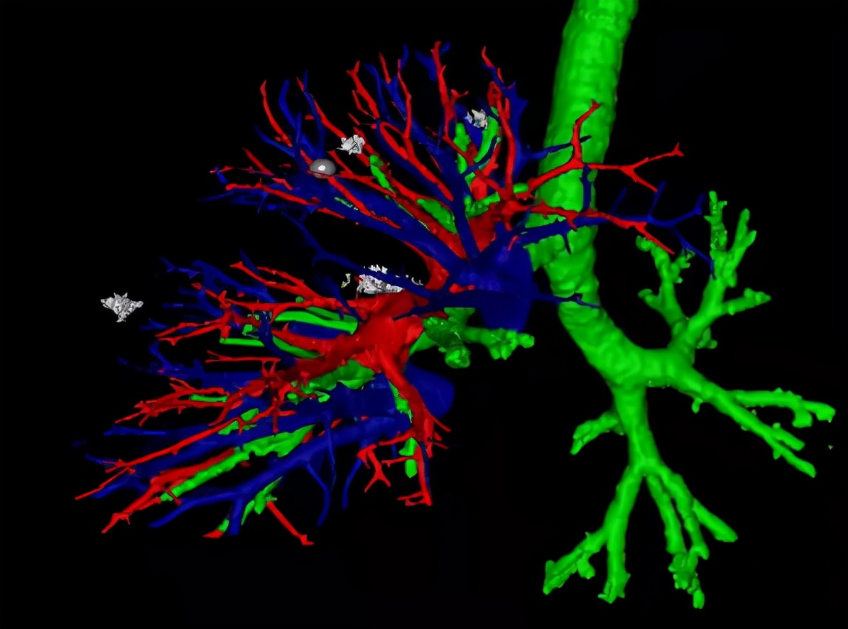 小單孔、廣“排雷”——多發(fā)結(jié)節(jié)的外科治療