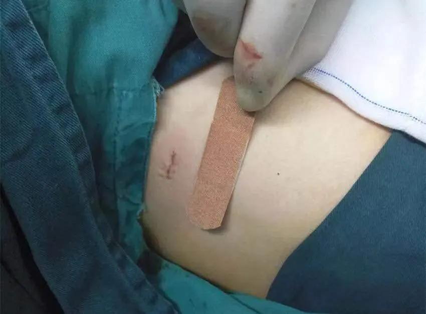 雙手四季“滴汗如雨”？微創(chuàng)手術(shù)來解憂