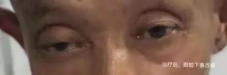 我院成功救治一例不典型免疫性心肌炎患者